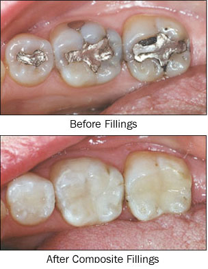 Routine Fillings - Horton Dental